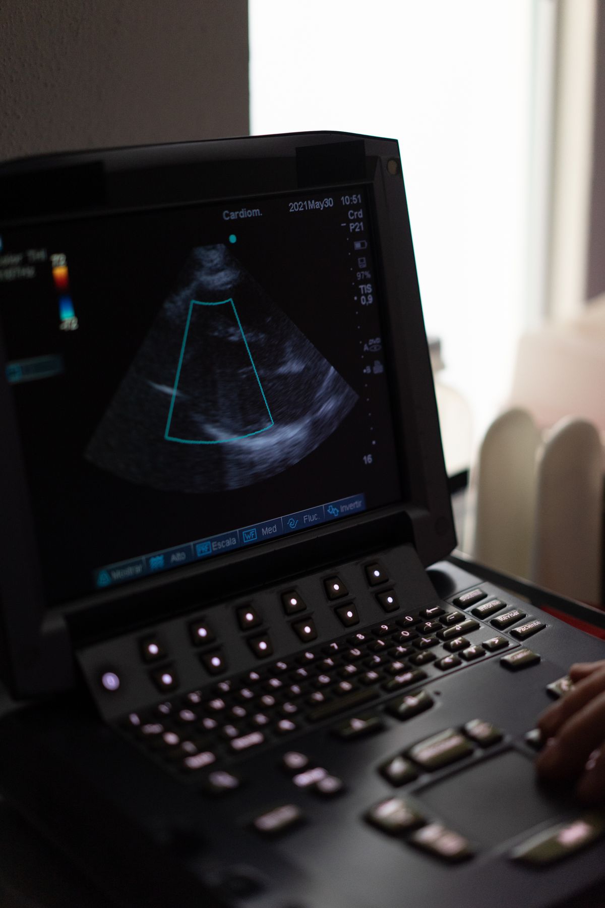An echocardiogram on the ultrasound machine display